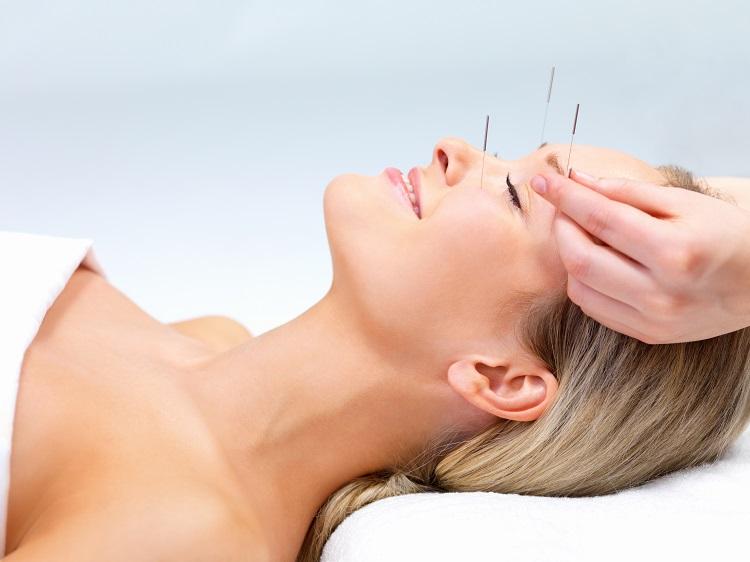 mulher deitada recebendo agulhas de acupuntura na testa.