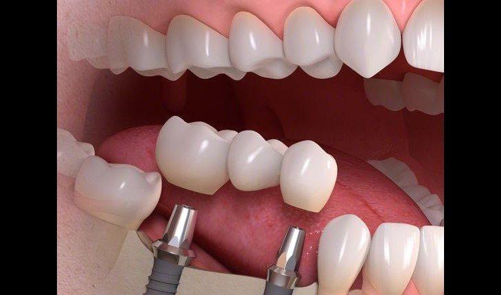 Implante dentário exemplo