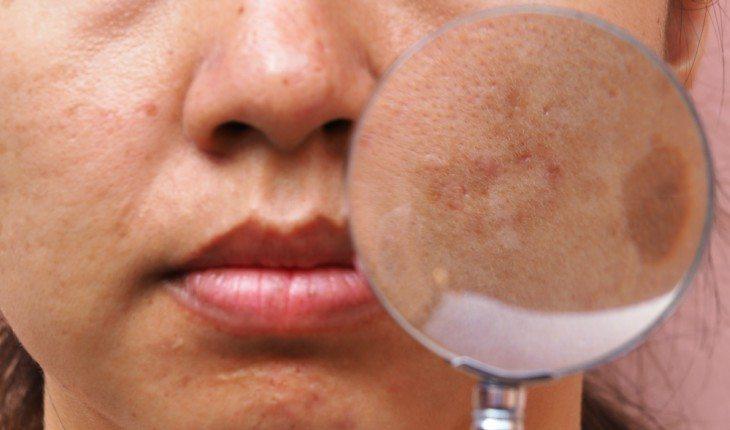 Manchas de limão na pele: como eliminar e quais cuidados tomar durante o verão
