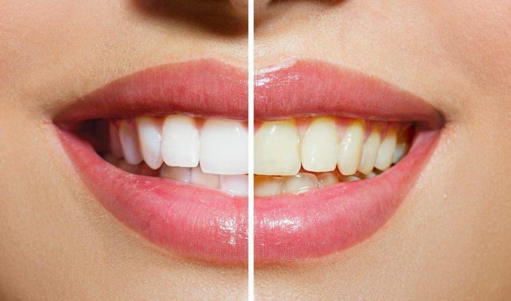 Dentes brancos e amarelos