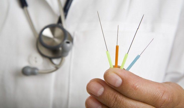 médico segurando agulhas de acupuntura