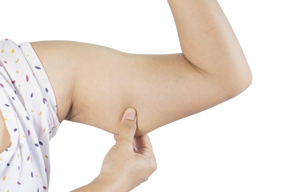 Mulher branca puxando a pele do braço para mostrar a flacidez antes do procedimento estético.