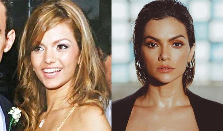 Harmonização facial: confira o "antes e depois" dos famosos