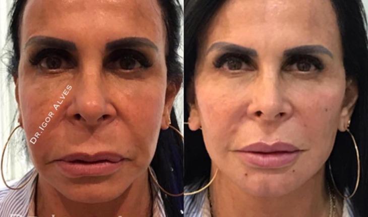 Harmonização facial: confira o "antes e depois" dos famosos