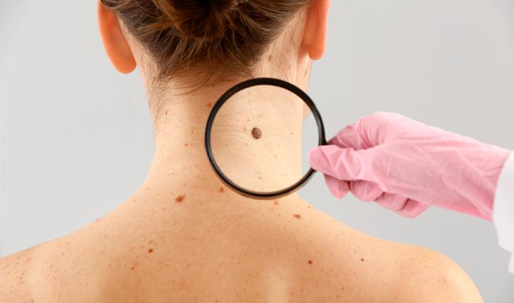 Dezembro Laranja: saiba como se prevenir do câncer de pele