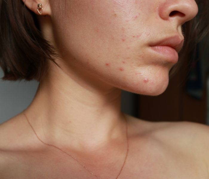 A acne é um dos problemas de pele que podem ser causados pelo estresse