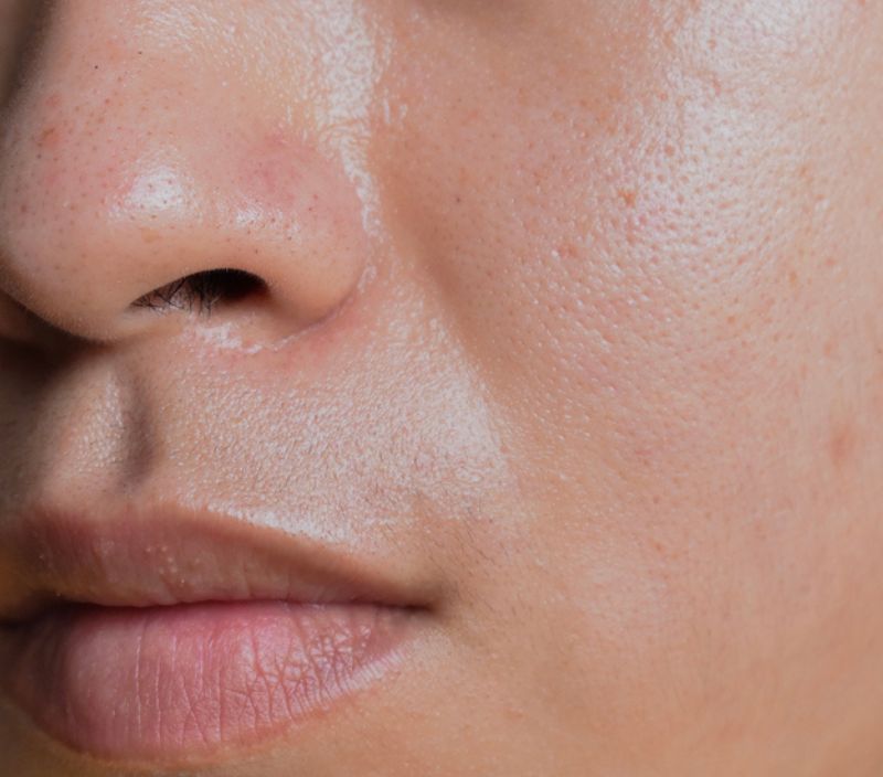 Segundo a Sociedade Brasileira de Dermatologia (SBD), a pele mista é a mais comum 
