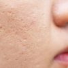 Saiba como cuidar da sua acne para prevenir as cicatrizes