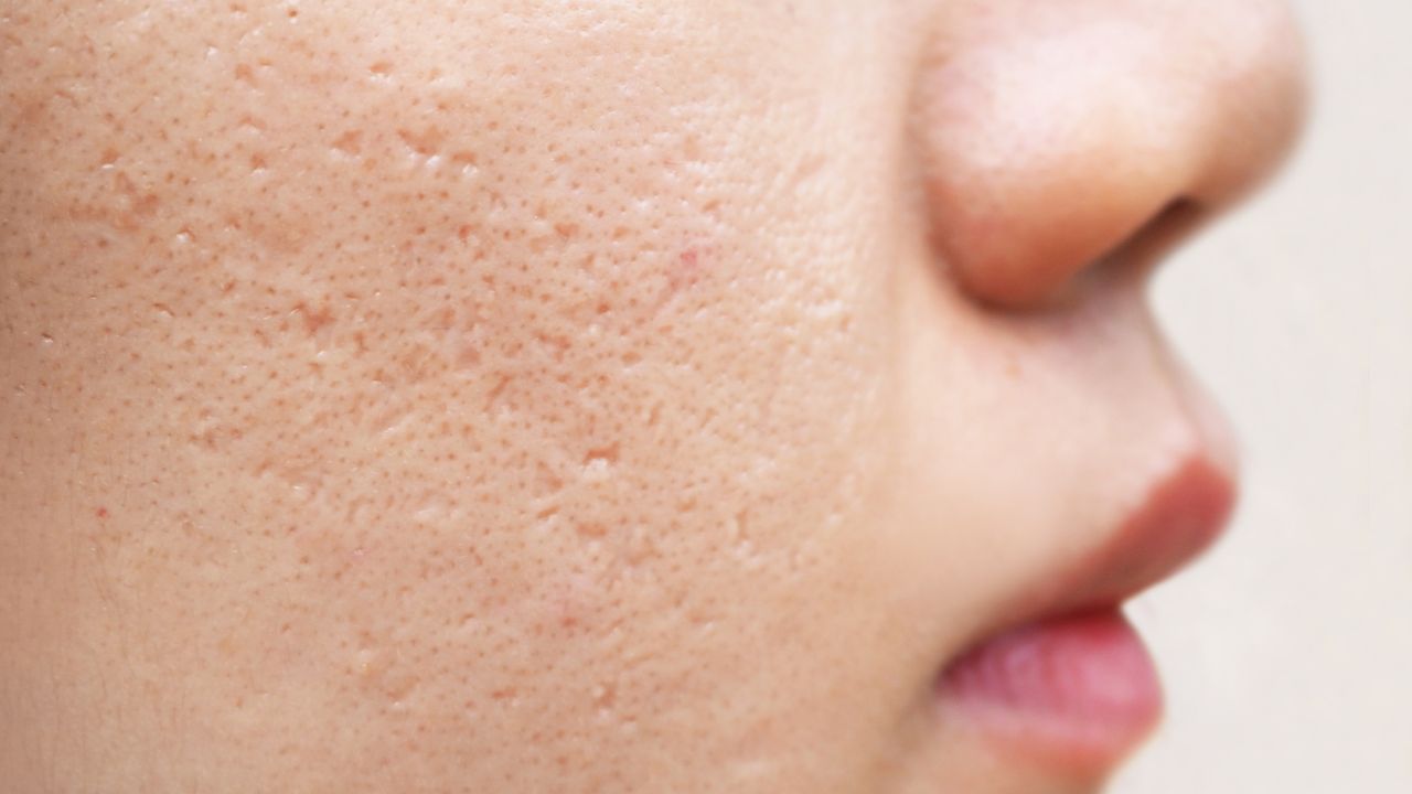 Saiba como cuidar da sua acne para prevenir as cicatrizes