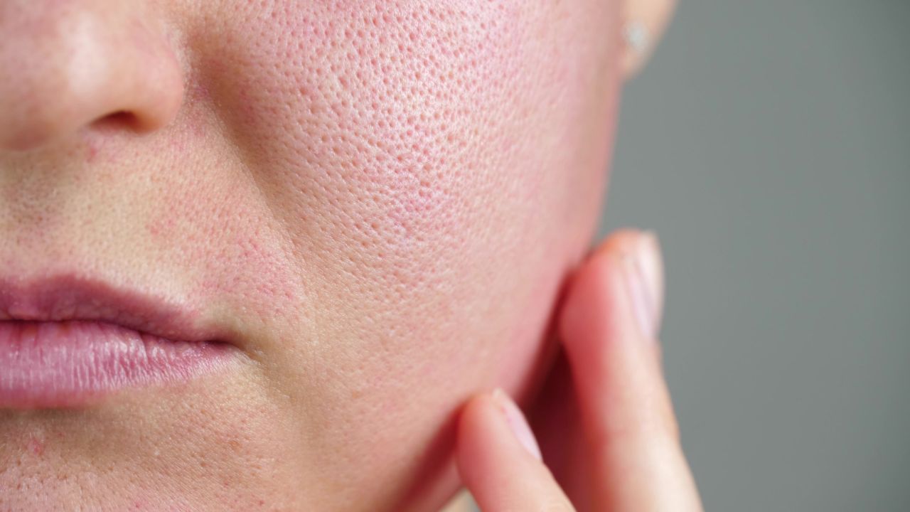 Se a sua pele é oleosa, essas dicas podem te ajudar
