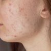 As lesões da acne adulta surge em locais como bochechas e queixo