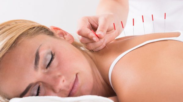 A acupuntura é uma técnica ligada à medicina chinesa que usa agulhas para estimular pontos no corpo