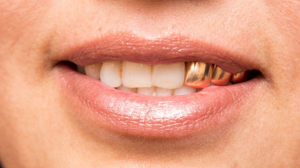 Dentes de ouro: saiba os riscos do acessório para a saúde bucal