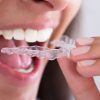 O uso de placas dos dentes melhora os sintomas do bruxismo