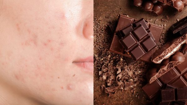 A ideia de que chocolate causa acne pode não ser um completo mito, mas também não é 100% verdade
