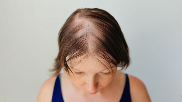 A alopecia pode afetar tanto homens quanto mulheres e conhecer seus sinais é importante