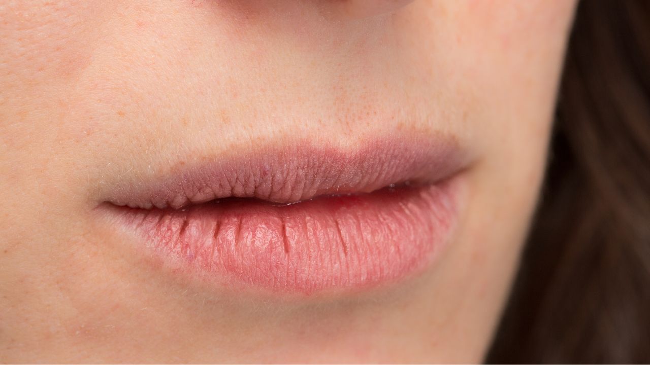 Lábios rachados: 4 dicas que ajudam a resolver o problema