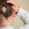 Alopecia: conheça as causas e o tratamento da condição