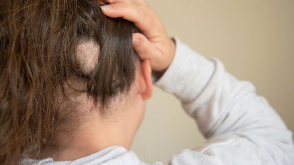 Alopecia: conheça as causas e o tratamento da condição