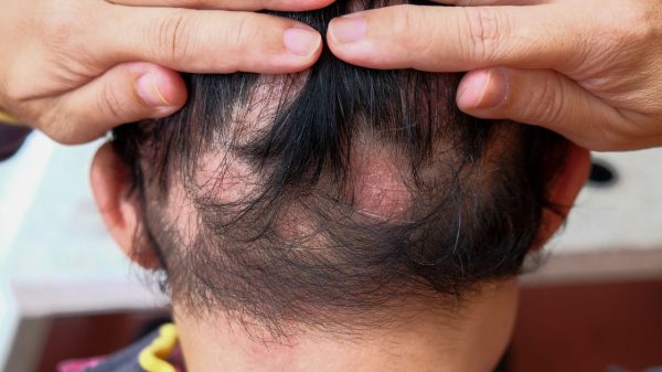 Alopecia areata: conheça a causa e tratamento da condição