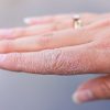 Veja como certos componentes podem ajudar a tratar as mãos ressecadas
