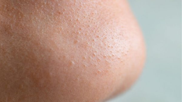 Veja como evitar poros dilatados