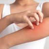 Saiba quais são as causas e os sintomas de alguns tipos de dermatites e alergias que surgem durante o verão