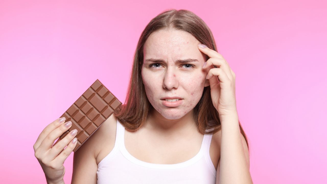 Entenda se o chocolate faz bem ou não para a saúde da pele e se influencia na piora do quadro de acne