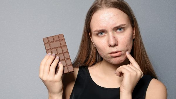 Chocolate dá espinha ou é mito? Descubra